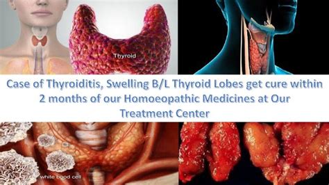 Case Of Thyroiditis Swelling Bl Thyroid Lobes And Homoeopathy
