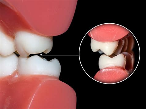 What Is Dental Occlusion
