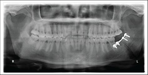 Late Mandible Fracture After Surgical Extraction Of Mandibular Third