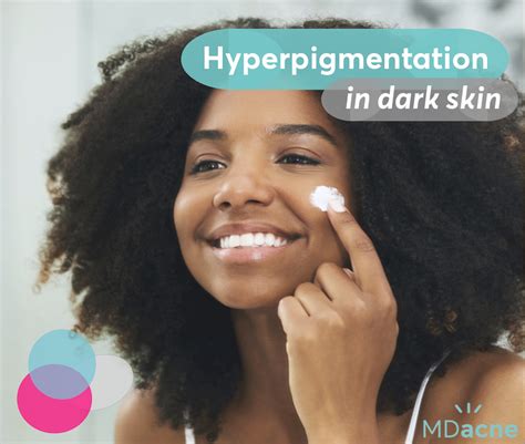 The Best Hyperpigmentation Treatment For Black Skin Mdacne