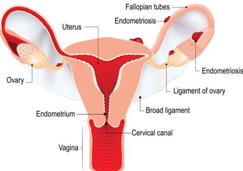 Cervical Endometriosis Fleur Womens Health Rancho Mirage