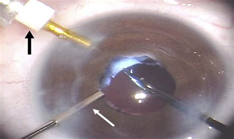 Surgical Technique For Anterior Segment Surgery In Pediatric Journal Of Cataract