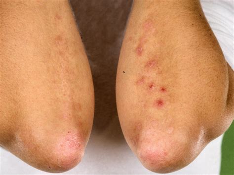 What Is Dermatitis Herpetiformis With Pictures My Xxx Hot Girl