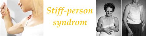Stiff Person Syndrom Příznaky Projevy Symptomy Příčina Léčba
