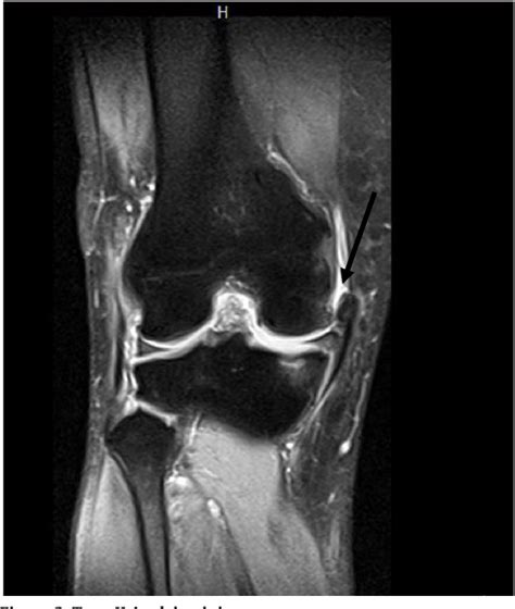 Figure 1 From Medial Collateral Ligament Injury A New Classification