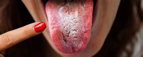 Covid Tongue A New Covid Symptom Radix Blog