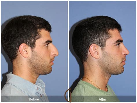 Rhinoplasty Surgery For Men Women And Teens Of All Ethnicities