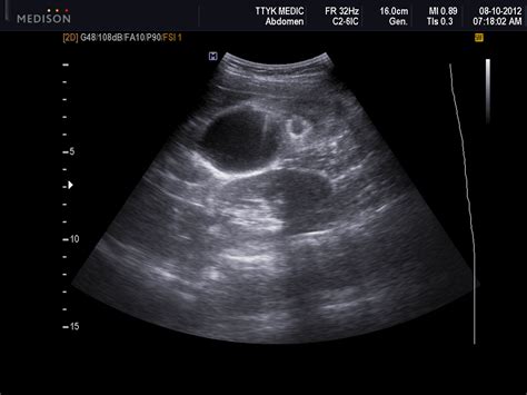 We did not find results for: VIETNAMESE MEDIC ULTRASOUND: CASE 144: ABNORMAL GALL ...