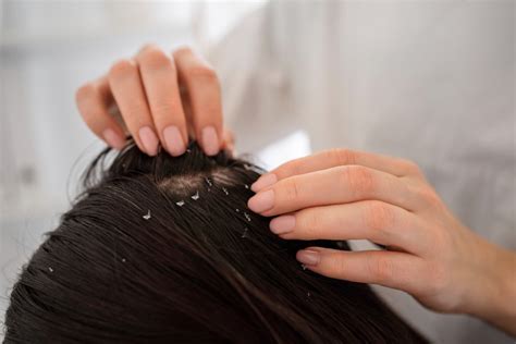 can dry scalp cause hair loss everything you need to know