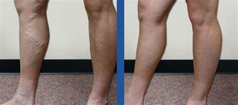 Vein Treatment Before And After Photos Charlotte