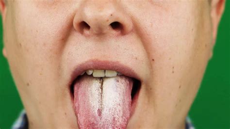 langue fissurée ou crevassée causes et traitement