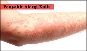 Penyakit Alergi Kulit Homecare