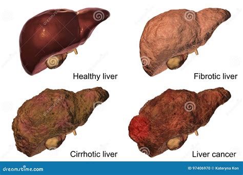 Fibrotic Liver In Obese Man 3D Illustration CartoonDealer Com 221560600