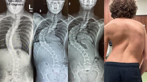 Severe Scoliosis Before And After