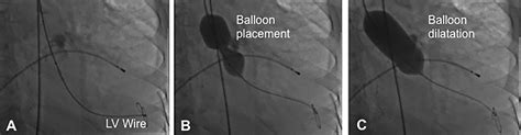 Percutaneous Balloon Aortic Valvuloplasty In The Era Of Transcatheter