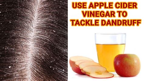 Use Apple Cider Vinegar To Control Dandruff Dandruff Youtube