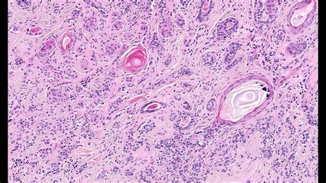 Microcystic Adnexal Carcinoma Part 1 Phillip Mckee Corey Georgesen