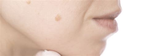 Benign Skin Growth Ancaster Dermatology Ancaster Dermatology