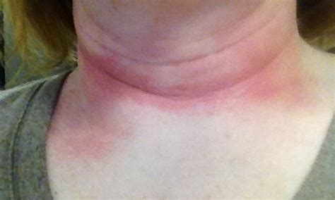 Itchy Neck Pictures Rash Causes Diagnosis Treatment HealthMD