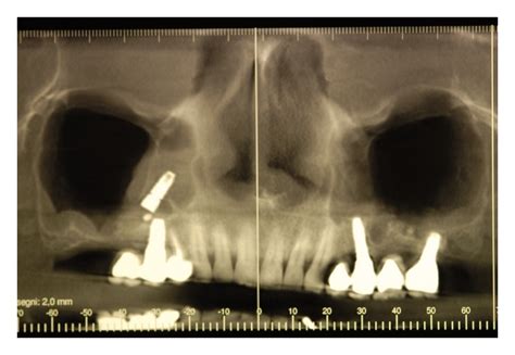 Figure 1 Removal Of A Dental Implant Displaced Into The Maxillary