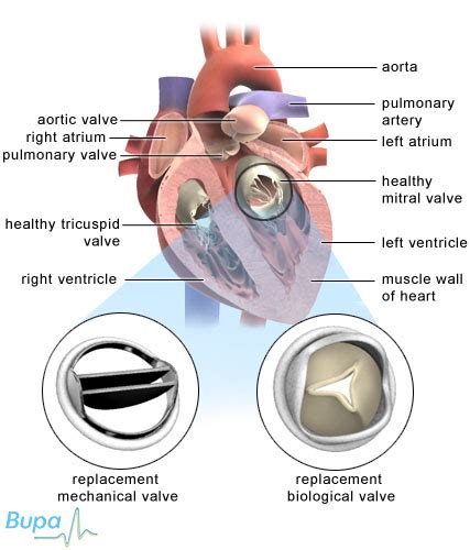Valve Replacement Surgery Bicuspid Aortic Valve Replacement Surgery