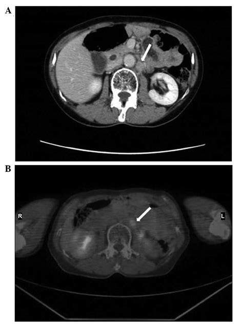 Sigmoid Colonic Metastasis By Lymphatic Spread Occurring With