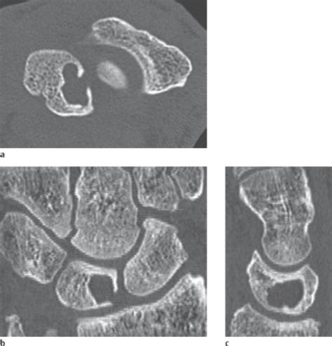 43 Cystic Bone Lesions Radiology Key