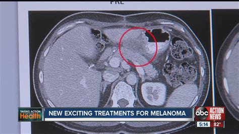 New Exciting Treatments For Melanoma Youtube