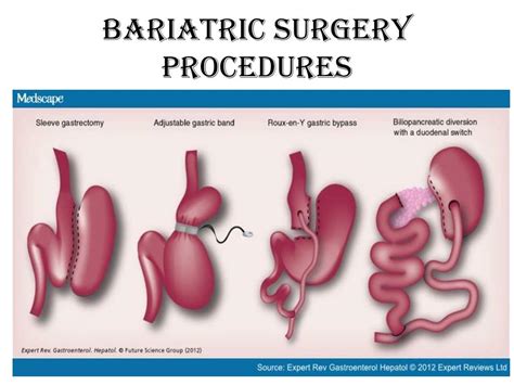 Ppt Bariatric Surgery The Psychiatric Perspective Powerpoint