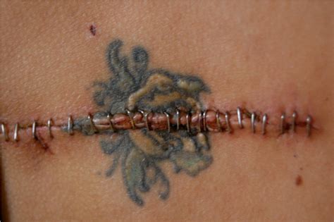 Consider whether you want the option to. Tattoos and melanoma: How to protect against skin cancer ...