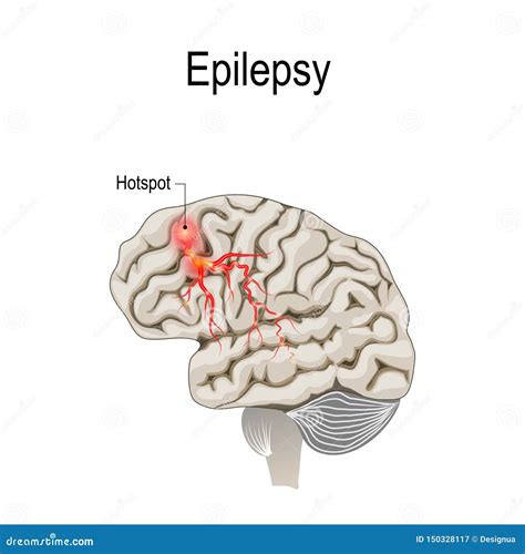 Menselijke Hersenen Met Hotspot Hotspot Van Epilepsie Vector