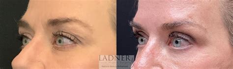 Eyelid Surgery Blepharoplasty Before And After Pictures Case Denver CO Ladner Facial