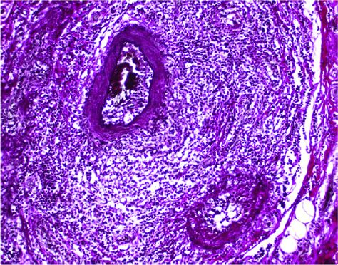 Acute Inflammatory Vasculitis Involving Artery Near Branch Point With