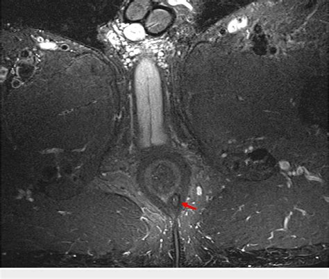 Figure 1 From Solitary Rectal Ulcer Syndrome Mimicking Perianal Crohns