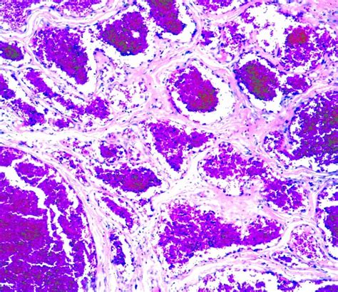 Pathology Outlines Cavernous Hemangioma
