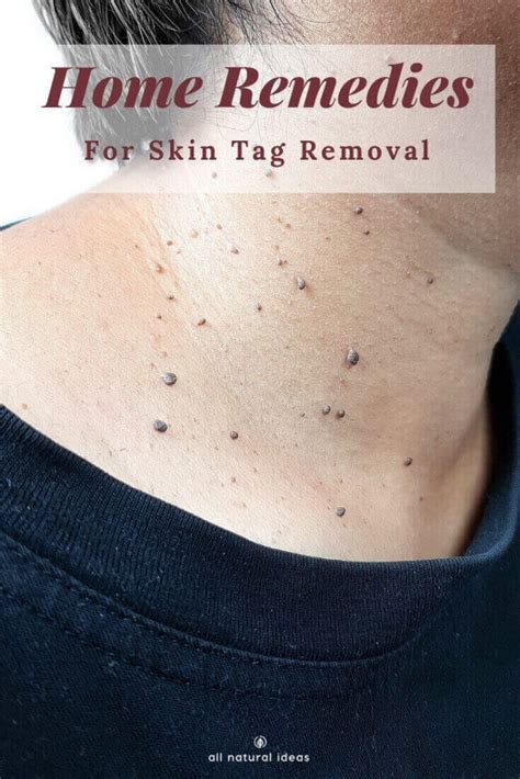 home remedies for skin tags removal to try all natural ideas