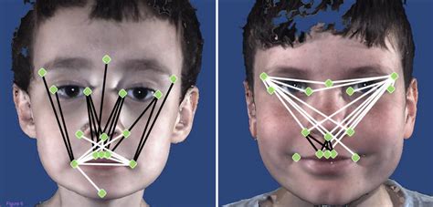 Symptoms of aspergers in adults. cracking the enigma: The many faces of autism