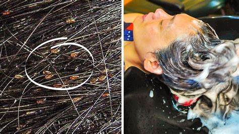 How To Get Rid Of Lice Nits Permanently In One Day Without Comb
