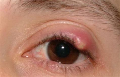 Ingrown Eyelash On Upper Eyelid Removal Treatment Symptoms Bump