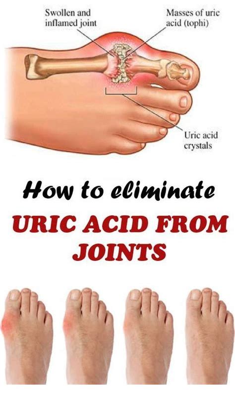 How To Remove Uric Acid Crystalization In Joints Gout And Joint Pain