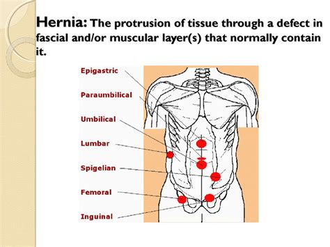 Hernias De La Pared Anterior Y Lateral Del Abdomen Kulturaupice