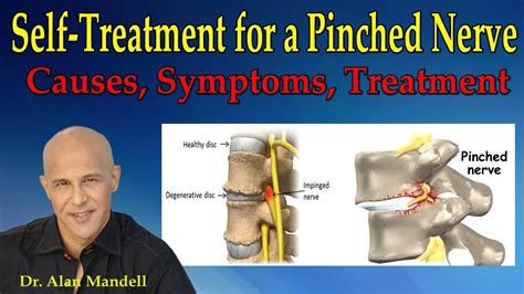 Self Treatment For A Pinched Nerve Causes Symptoms Treatment Dr