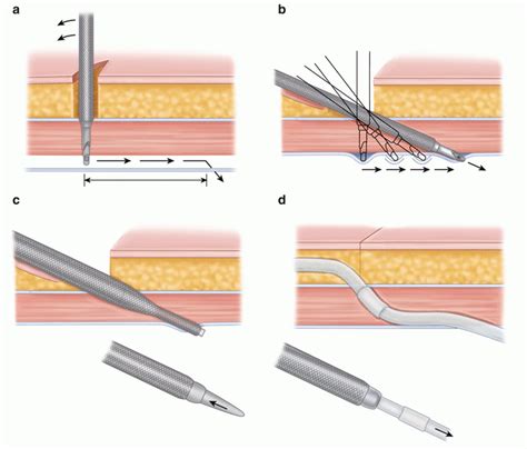 Advanced Laparoscopic Insertion Of Peritoneal Dialysis Catheters