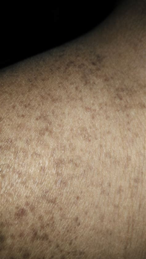 Brown Spots Above And Around Left Ankle Dermatology Skin And Nails