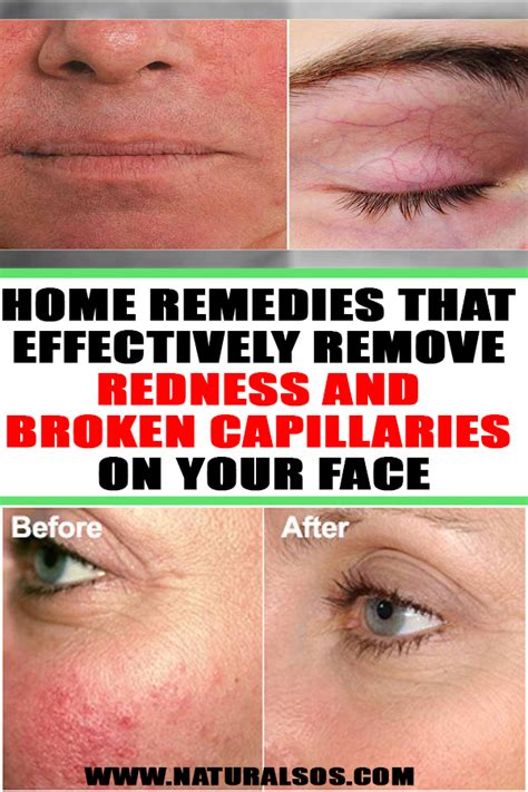 Home Remedies That Effectively Remove Redness And Broken Capillaries On