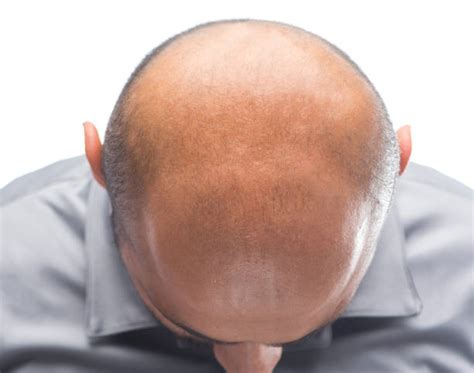 Back Of Head Completely Bald Shaved Head Balding Stock Photos Pictures