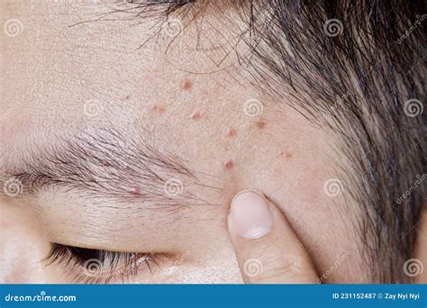 Acne Mechanica Or Sports Induced Acne Or Whiteheads Or Mild Acne At