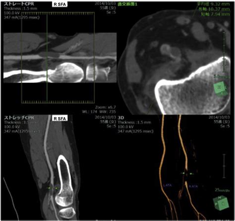 Diagnosis of adventitial cystic disease of the popliteal artery by ...