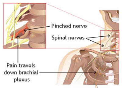 While shoulder impingement can be painful and affect your daily activities, most people make a full recovery within a few months. NYC Pinched Nerve in Neck Treatment Doctor (Top Rated Neck ...