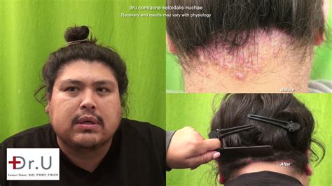 Painful Bump On Back Of Head Removed With Surgical Treatment Youtube